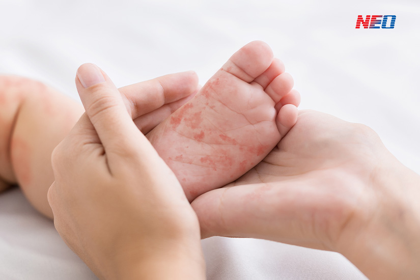 มือเท้าปาก เกิดจากอะไร